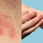 Herpes z&oacute;ster facial/ Viruela del mono.- Fotos, fuente externa